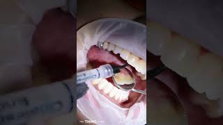 Internal Bleaching treatment on root canal treated tooth by Dr Terence Moodley dentist  dentistry [upl. by Cornall686]