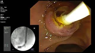 ERCP  Post partial cholecystectomy with retained CBD stone removal with prophylaxis stenting [upl. by Petronilla]