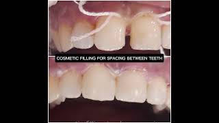 TOOTH COLOR COMPOSITE FILLING TO CLOSE GAP BETWEEN FRONT TEETH [upl. by Settera]