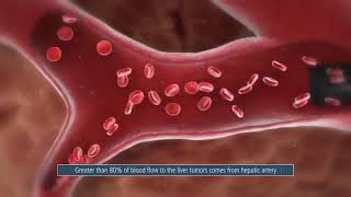 Thera Sphere Advanced 3D Technology Tumor Treatment  Mechanism of Action Drug Delivery Microsphere [upl. by Anotyad]