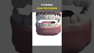 Pyorrha Gum Recession pyorrhea dentalfilling dentaltreatment teethwhitening dentalbraces ortho [upl. by Natam]