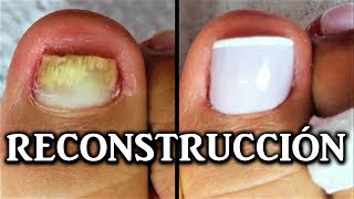 reconstruccion de uñas de pies con acrilico  nail reconstruction  reconstrução de unhas acrílico [upl. by Cirilo206]