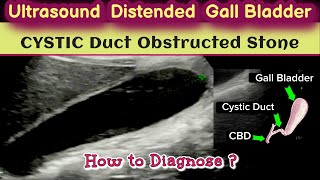 Ultrasound Distended Gall bladder  Cystic Duct Stone  How to Diagnose [upl. by Johiah]