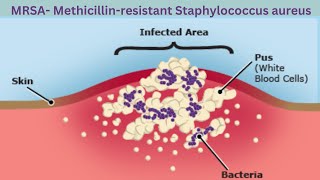 What is MRSA Methicillin Resistant Staphylococcus Aureus [upl. by Naryk299]