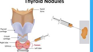 Fine needle aspiration of thyroid nodules [upl. by Hennahane964]