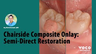 Chairside Resin Composite Onlay SemiDirect Restoration ǀ Die Silicone VOCO GmbH [upl. by Licht]