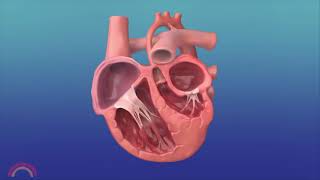 InUtero Procedure to Reverse Hypoplastic Left Heart Syndrome [upl. by Aneez]