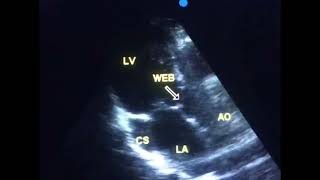 Sub aortic stenosis is it a congenital heart disease  to drahmadmirdamadisiKiJIzZBvYvqoKkZ [upl. by Anirahc]