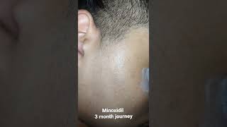 minoxidil 5 beard growth 3 month journey mintop minoxidil [upl. by Meece212]