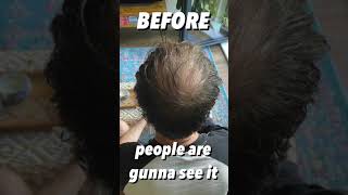 BALDING Man Gets A VIKINGS BUZZ CUT TRANSFORMATION [upl. by Mor]