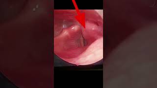 Normal Larynx vs Larynx Cancer  Fixed vocal cord Hoarse voice  आवाज़ ख़राब होना shorts viral [upl. by Amo]