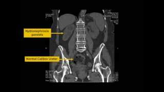 Ureteroscopy and Ureteric Tumour [upl. by Ahsilac]