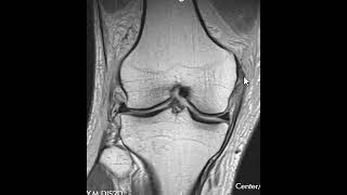 Medial collateral ligament sprain [upl. by Berke]