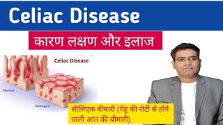 Celiac disease Cause Symptoms Tests and Treatment explained in Hindi  Gluten Enteropathy [upl. by Suhpesoj]