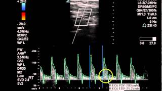 Duplex Exam of Subclavian Arterial Disease  Case Study [upl. by Liggett201]