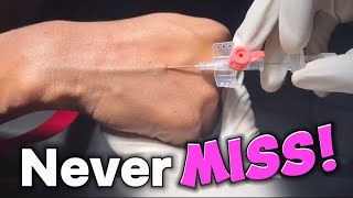 IV Cannulation Expert Technique Under 3 minutes [upl. by Sucerdor]