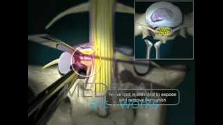 3D Medical Animation  Minimally invasive endoscopic discectomy [upl. by Ralyks767]