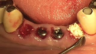 Socket preservation using alloplastic graft material OSTEON™ [upl. by Teufert822]