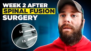 Beginning the Journey What To Expect in Weeks 1 amp 2 after L4L5 Spinal Fusion Recovery [upl. by Ciredec]