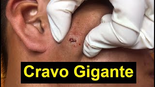 Tratamento cravos e espinhas  Cravo gigante inflamado [upl. by Pachton475]