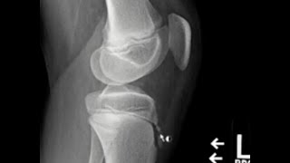 OsgoodSchlatter disease [upl. by Yerfdog32]