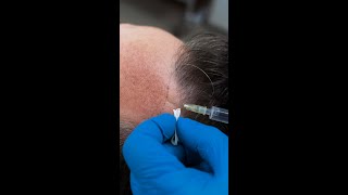 PRP para tratar la alopecia ¿FUNCIONA [upl. by Asirehc]