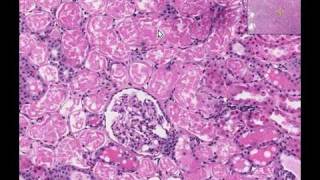 Histopathology Kidney Acute tubular necrosis [upl. by Stringer]