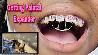 Getting Palatal Expander And She Not Too Happy [upl. by Yob]