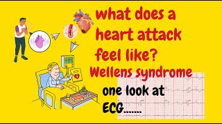 Heart attack  Anterolateral STEMI ST elevation  Wellens syndrome  myocardial infarction ECG [upl. by Aciretahs]