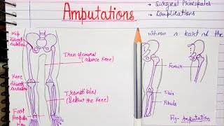 Amputation introduction indications types complications [upl. by Yorgen]