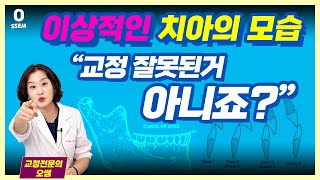 돌출입교정 이것 모르면 낭패  이상적인 치아 교합 관계 치아교정 과개교합 옥니 치아교정실패 치아교정전후 [upl. by Branch]