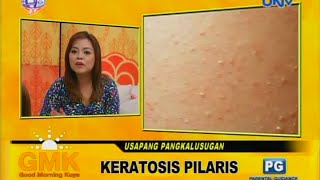 Keratosis Pilaris chicken skin [upl. by Eelame]