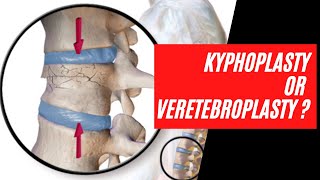 Vertebroplasty vs Kyphoplasty vs Spine Jack Whats best for a fixing a broken bone in your back [upl. by Atela]