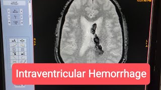 How to Diagnose Intraventricular Hemorrhage on MRI of Brain [upl. by Larkin427]