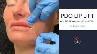 PDO Thread Lip Lift [upl. by Ray]