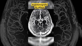 ANGIOTOMOGRAFÍA DE CABEZA [upl. by Edina271]