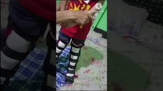 Cerebral palsy AFOOrthosis support [upl. by Nelleoj]