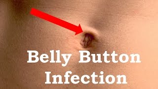 How to Treat Belly button Infection [upl. by Acissey635]