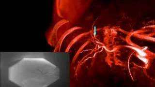 Medical Imaging Registration of Angiographic Images [upl. by Lon651]