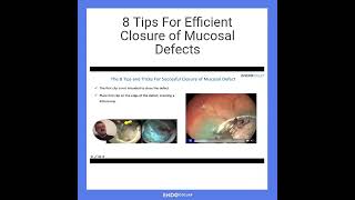 8 Tips For Efficient Closure of Mucosal Defects [upl. by Scherman457]