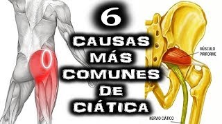 CIATICA DOLOR LAS 6 CAUSAS MÁS COMUNES DE CIÁTICA ¿CUÁL TIENES TÚ La Verdadera Cura Sin Mentiras [upl. by Oulman]