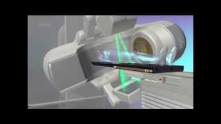 Spine Tumor Treatment  Truebeam STx  Phoenix CyberKnife [upl. by Sturdivant]