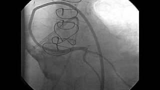 Left Ventricular Dysfunction after Heart Transplantation [upl. by Cyprian746]