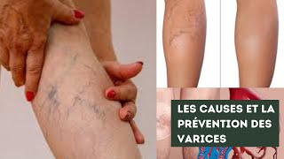 Comment prévenir et traiter les varices et les varicosités [upl. by Swords]