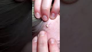 Pimple popping loan nguyen 2022  Cystic acne blackhead whitehead removal today [upl. by Fritts]