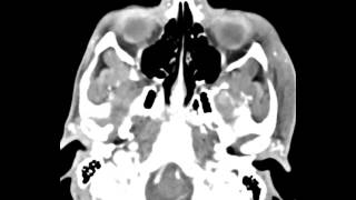 Mandibular Condyle Osteochondroma [upl. by Anerrol]