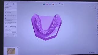 3Shape Aufbissschiene [upl. by Yrneh301]