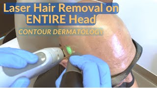 He Wanted His Entire Head Treated with Laser Hair Removal [upl. by Kabab]