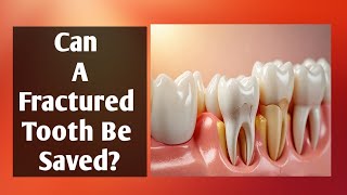 Saving a Fractured Tooth and why you shouldnt get it pulled [upl. by Eneloj]