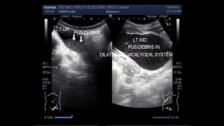 Pyonephritis associated with pyoureter in a child aged 9 years [upl. by Lindsey]